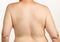 Bare back of overweight middle aged woman with moles and other skin irregularities