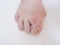 Bare foots which have Hallux Valgus problem.