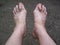 Bare foots which have Hallux Valgus problem.