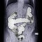 Barium enema image or x-ray image of large intestine Prone position.