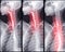 Barium Swallow procedure UGI throat bowel therapy by fluoroscopy devices