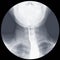 Barium swallow x-ray Evidence of achalasia at distal esophagus to EG junction.Moderate proximal dialtation of esophagus with