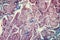 Basal cell cancer Diseased tissue