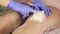 Beautician hands in a blue rubber glove remov unwanted leg hair with shugaring.