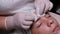 Beautician squeezes acne on the forehead of a teenage boy. Closeup of hands in white gloves in beauty clinic. Male client gets fac