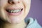 Beautiful caucasian young girl in dental braces smiles. Teenage concept. Design of braces on teeth. Banner for dental clinic.