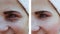 Beautiful girl face wrinkles, acne beautician cosmetology medicine patient before and after the procedure