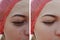 Beautiful girl face wrinkles, swollen acne beautician cosmetology medicine patient before and after the procedure