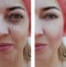 Beautiful girl face wrinkles, swollen health acne beautician cosmetology medicine patient before and after the procedure