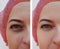 Beautiful girl wrinkles on face before and after pigmentation regeneration procedures, pimples