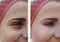 Beautiful girl wrinkles on face regeneration anti effect cosmetology before and after procedures