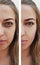 Beautiful girl wrinkles on face before and after removal pigmentation regeneration procedures, pimples