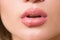 Beautiful lips virus infected herpes