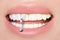 Beautiful white teeth for women blond. Teeth whitening by the dentist.