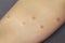 Bedbug bites. Body with skin problem. Infectious disease. Allergy, dermatitis, virus or bacterial infection. Dermatology,
