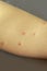 Bedbug bites on skin. Human leg close up