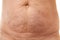 Belly of a 40 year old woman with postpartum stretch marks close up
