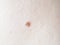 Benign moles on human skin, close up