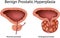 Benign Prostatic Hyperplasia