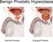 Benign Prostatic Hyperplasia