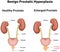 Benign Prostatic Hyperplasia