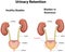 Benign Prostatic Hyperplasia