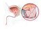 Benign prostatic hyperplasia BPH, enlarged prostate with bladder, urethra and seminal vesicle, medical illustration