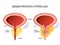 Benign prostatic hyperplasia BPH. prostate enlargement