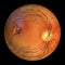 Best vitelliform macular dystrophy, Atrophic stage, retinal atrophy, 3D illustration