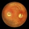 Best vitelliform macular dystrophy, Pseudohypopyon stage, layering of lipofuscin, illustration