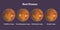 Best vitelliform macular dystrophy stages, scientific illustration