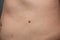 Big birthmark on the man` skin. Medical health papilloma photo