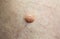 Big birthmark on skin. Medical health photo. Papillomas on human body