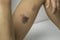 Big Bruise on child thigh