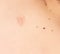 Big scar and moles on the skin of a person on the back, copy space, dermatology