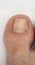 big toenail of a person suffering from onychomycosis, a fungal infection that causes yellowing of the nail