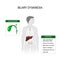 Biliary dyskinesia. Vector illustration for medical use