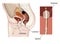 Biofilm formation on catheter