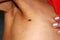 Birthmark of the armpit. Popiloma is large.