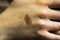 Birthmark or mole on the skin of the hand. Can be used for the concept of removing birthmarks