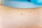 A birthmark or a mole on a woman skin