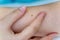 A birthmark or a mole on a woman skin