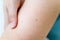 A birthmark or a mole on a woman skin