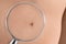 Birthmark of patient under magnifying glass, closeup. Visiting dermatologist