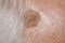 Birthmark of a teratoma on the skin of an old mans head close-up