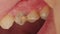 A black dead tooth in which a piece of tooth enamel is chipped off, a tooth chip. The concept of dental restoration in