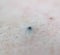 Black pimple acne on human skin, background. Acne and acne treatment, cosmetology, hygiene