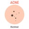 Blackhead skin acne type