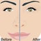 Blackheads remove on Nose treatment before and after. Pore reduce skin problems