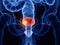 Bladder cancer